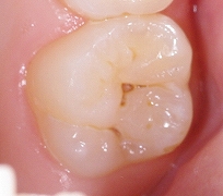 初期 画像 虫歯